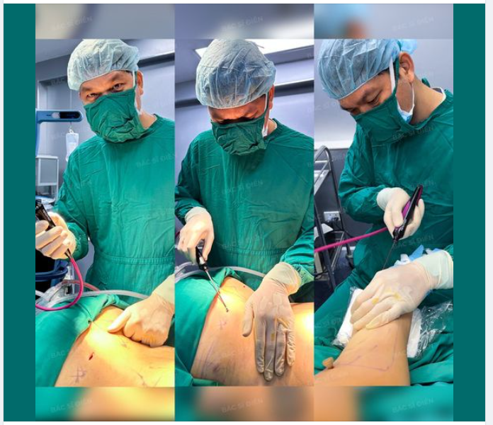 Thông thường, sau khi đưa mỡ thừa ra khỏi cơ thể, vùng da trên bề mặt thường sẽ bị lão hóa, da lỏng lẻo, chảy xệ, mất thẩm mỹ,...