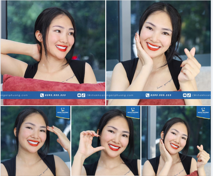 Khoe với mọi người chị khách Xuân Mộc - fan bự xem clip của bác sĩ Tuấn quá 180 phút 1 ngày nên đã quyết định làm răng sứ để cười đẹp và xinh hơn.