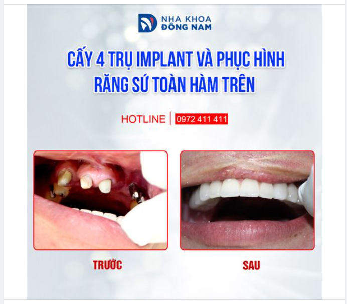 TĂNG SỨC NHAI thôi chưa đủ, PHẢI ĐẸP, TỰ NHIÊN mới là kết quả cấy Implant hoàn hảo