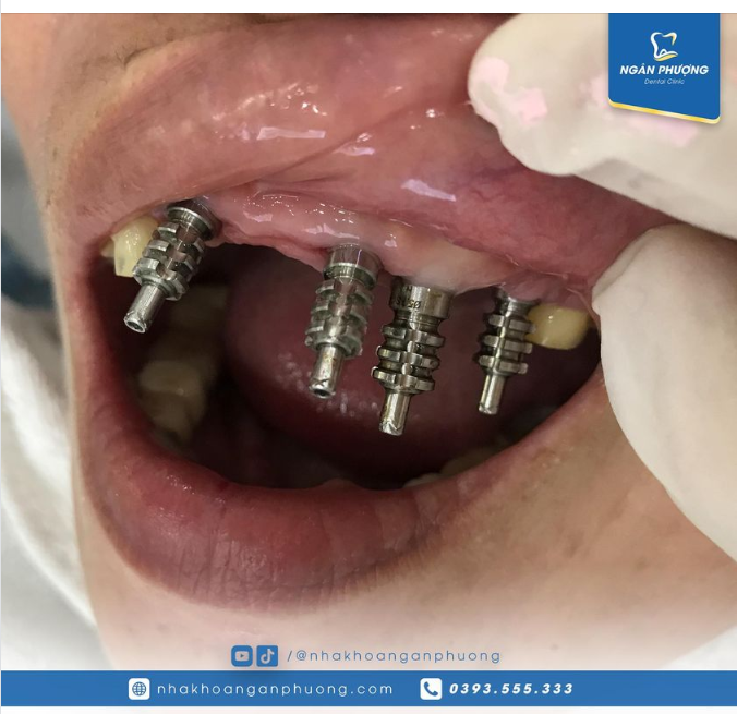 Ở tuổi ngoài 60, cô vẫn có thể cắm 4 implant một lúc, đủ thấy việc trồng răng không đau hay khó chịu như lời đồn.