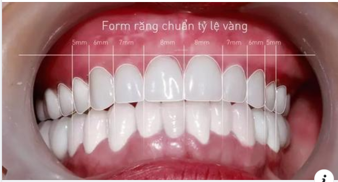 5 tiêu chuẩn hàm răng đẹp tự nhiên mà bạn nên biết