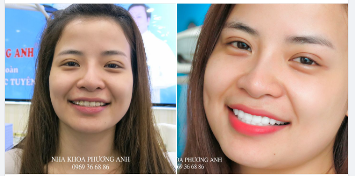Những điểm đặc biệt của răng sứ thẩm mỹ