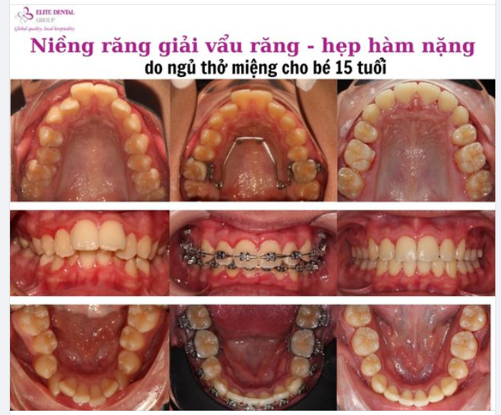 ĐIỀU TRỊ HÔ - HÀM HẸP NHIỀU CHO BÉ 15 TUỔI CÓ THÓI QUEN THỞ MIỆNG TỪ NHỎ