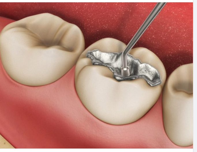 Cách chăm sóc răng sau hàn trám điều trị sâu