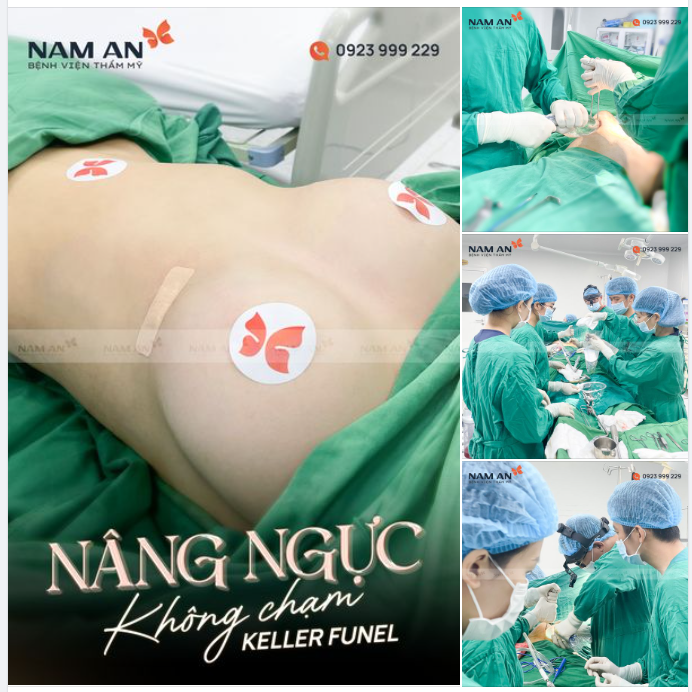 NÂNG NGỰC KHÔNG CHẠM - KELLER FUNEL