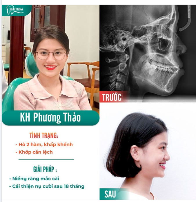 NẾU BIẾT TRƯỚC TÔI ĐÃ NIỀNG RĂNG SỚM HƠN
