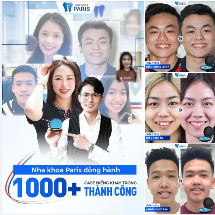 Tin Được Không Niềng Răng Trong Suốt Invisalign bắt đầu từ 20 Triệu Trả góp sau 6 tháng