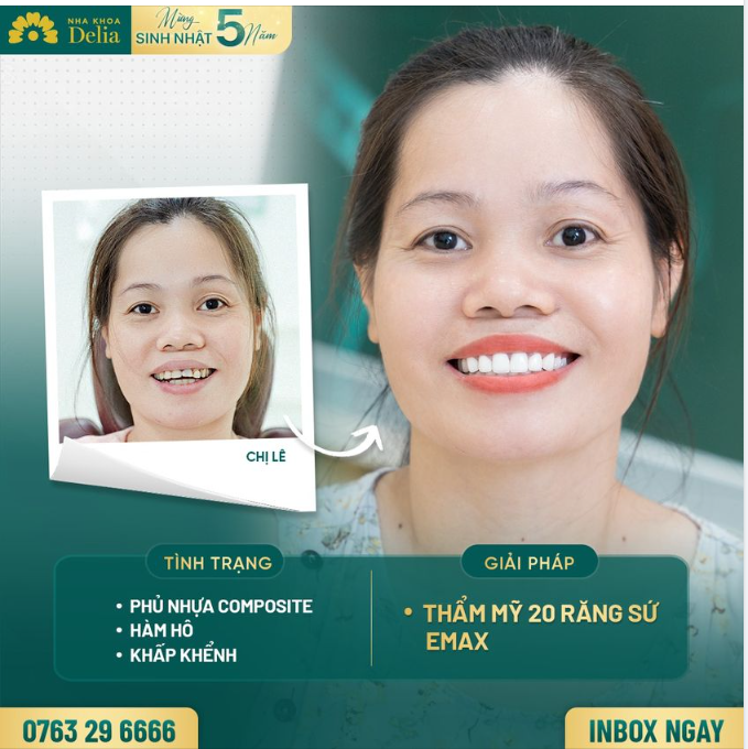 Kết quả không làm chị Lê thất vọng với nụ cười răng sứ trắng sáng, đều đẹp, khỏe mạnh tràn đầy tự tin.