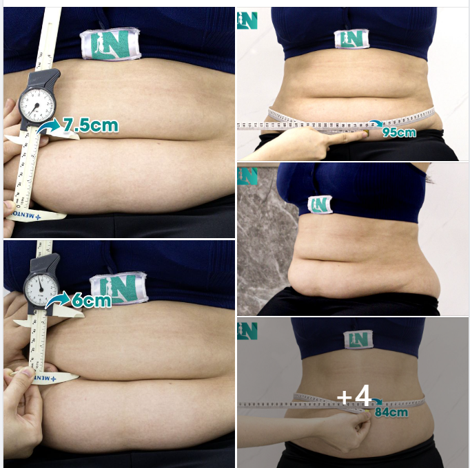  HÚT MỠ TẠO DÁNG THẨM MỸ VÙNG BỤNG CHO CHỊ KH TRẺ CHƯA LẬP GIA ĐÌNH: KHAO KHÁT CHẠM TAY ĐƯỜNG EO THẮT ĐÁY BẰNG GIẢI PHÁP GIẢM MỠ AN TOÀN, KHÔNG CAN THIỆP CĂNG DA. 