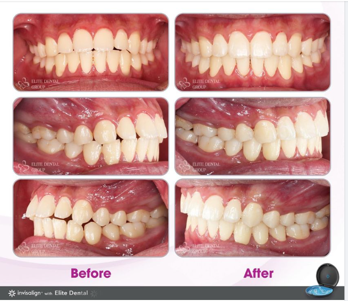 Chỉ mất 1 năm để thay đổi và sở hữu nụ cười mới rạng rỡ, tươi sáng giúp bạn sẵn sàng bước lên máy bay tới thành phố Nữ Thần Tự Do.