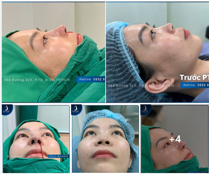 Kết quả mũi cấu trúc sụn tai cho chị gái đến từ Đồng Nai