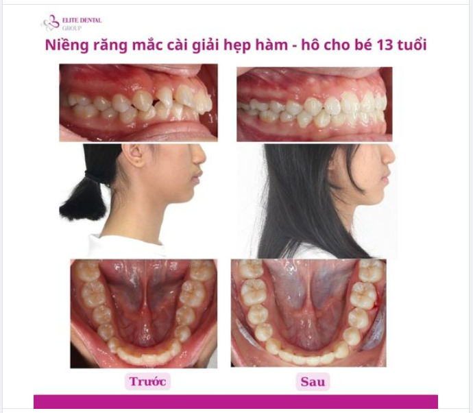 NIỀNG RĂNG MẮC CÀI GIẢI HẸP HÀM - HÔ CHO BÉ 13 TUỔI
