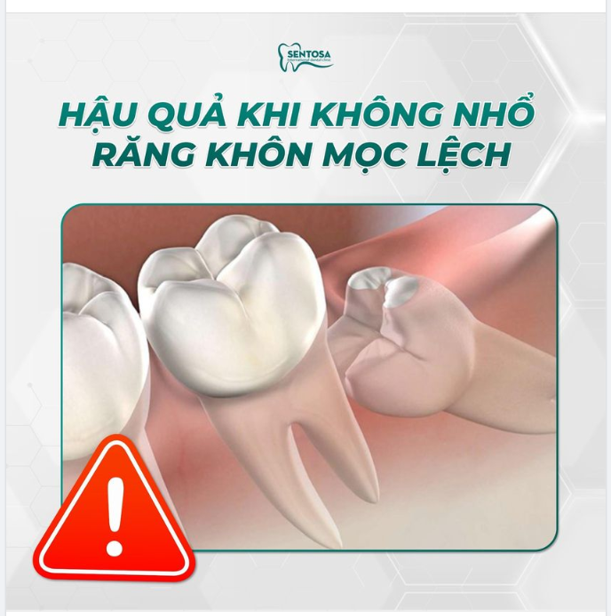 HẬU QUẢ KHI KHÔNG NHỔ RĂNG KHÔN MỌC LỆCH