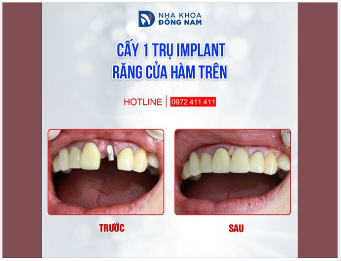 TRỒNG RĂNG GIẢ TỰ NHIÊN NHẤT CHO BỆNH NHÂN MẤT RĂNG CỬA