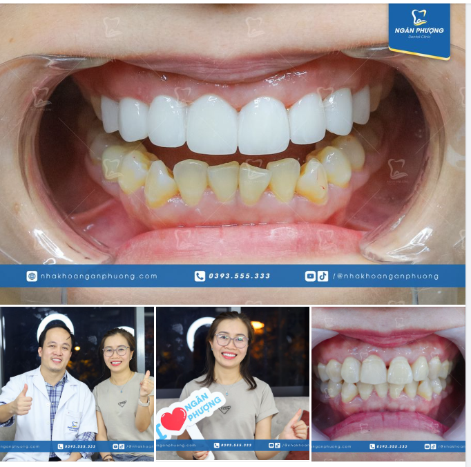Cảm ơn chị đẹp Hà Tĩnh vượt hàng trăm km làm răng với bác sĩ Giang trước thềm nghỉ lễ