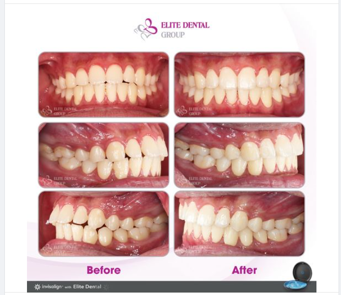 Tình trạng:Hô răng Thẩm mỹ môi chưa đẹp, có nhô nhẹ Răng có các khoảng hở nhỏ, Khớp cắn chưa chính xác.