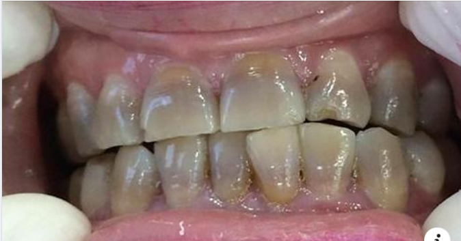 Răng nhiễm Tetracycline