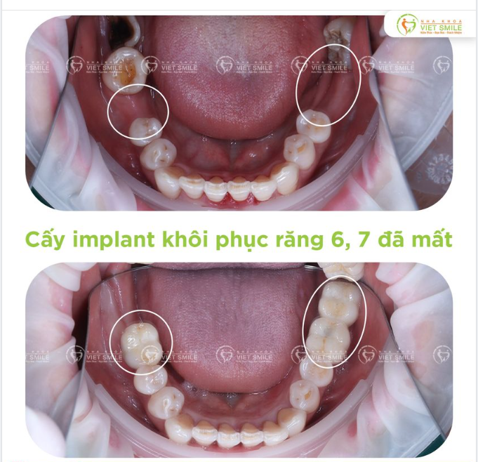 CẤY IMPLANT AN TOÀN - CHÍNH XÁC - HIỆU QUẢ