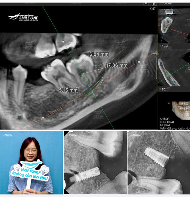 Trồng răng implant R36, R46 khách hàng Lê Đặng Lưu Ly 22 tuổi.