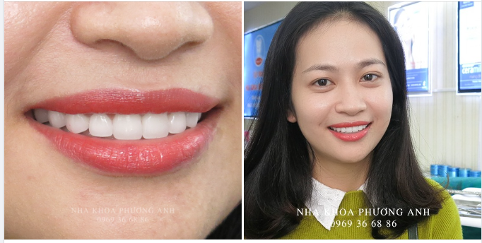 5 Cách Xóa Bỏ Nổi Lo Về Vấn Đề Hôi Miệng
