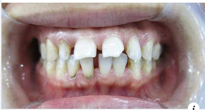 4 PHƯƠNG PHÁP ĐIỀU TRỊ RĂNG THƯA HIỆU QUẢ