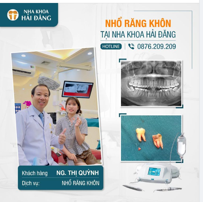 NHỔ RĂNG KHÔN MỌC NGẦM SIÊU KHÓ