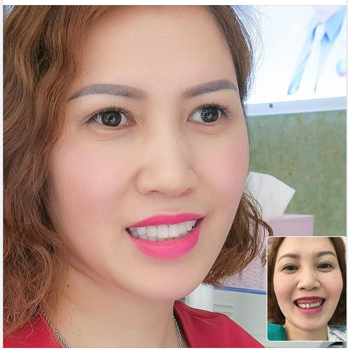 Độ bền của các loại răng sứ phổ biến hiện nay