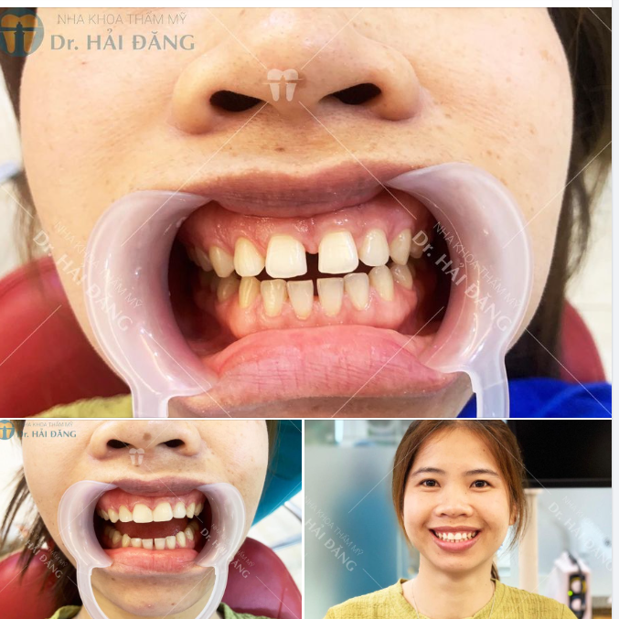 PHƯƠNG PHÁP ĐIỀU TRỊ RĂNG THƯA