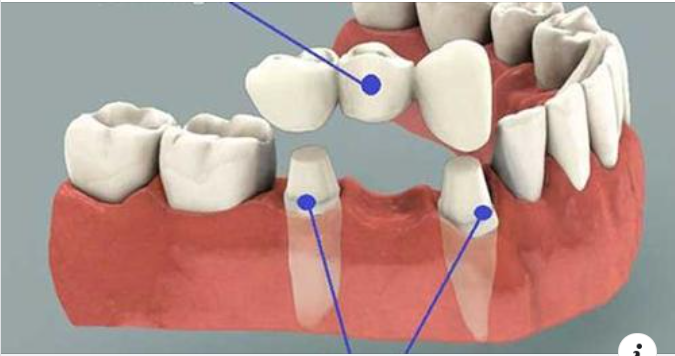 Làm cầu răng sứ có gây hôi miệng không ?