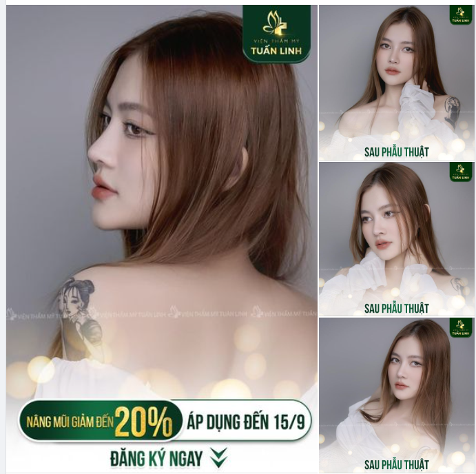 Khuyến mãi khủng giảm đến 20% các dịch vụ nâng mũi