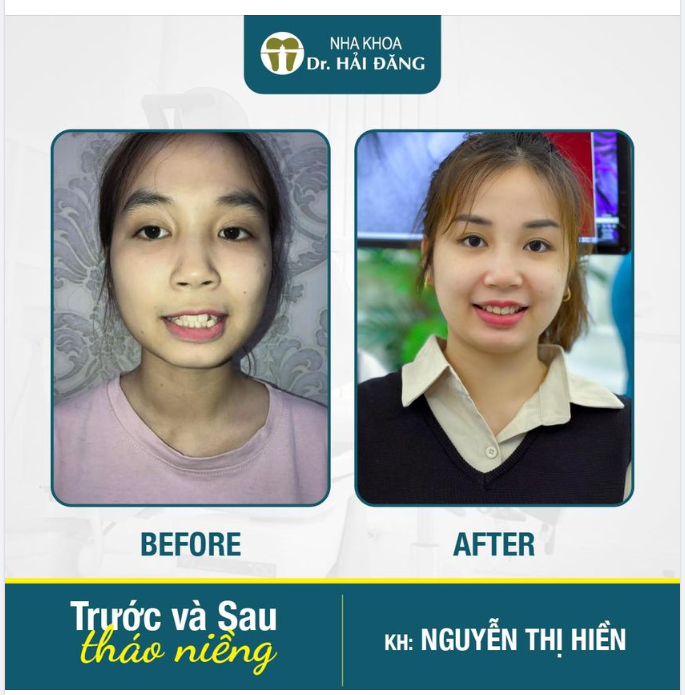 DÒNG FEEDBACK NGÀY THÁO NIỀNG YÊU THƯƠNG CỦA KHÁCH HÀNG