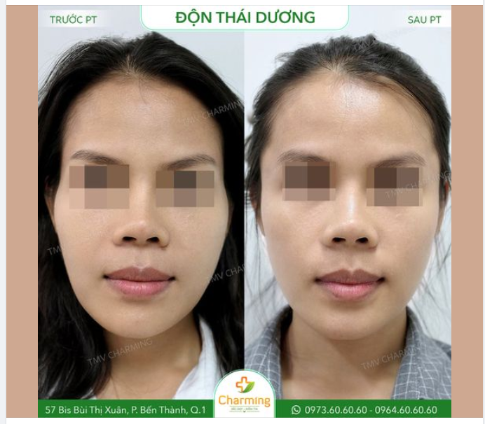 Trước phẫu thuật độn thái dương, bạn có thấy khuôn mặt của vị khách này trông rất hốc hác không?