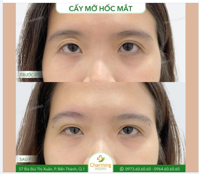 Hãy nhìn mí trên đôi mắt của cô gái này bạn nhé. Bạn có thấy dấu hiệu của một đôi mắt hốc do thiếu mỡ ở vùng giữa mí mắt và chân mày không? Đó chính là vấn đề của ca này đấy.