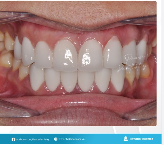 HÌNH ẢNH CA DÁN SỨ VENEER CHO KHÁCH HÀNG