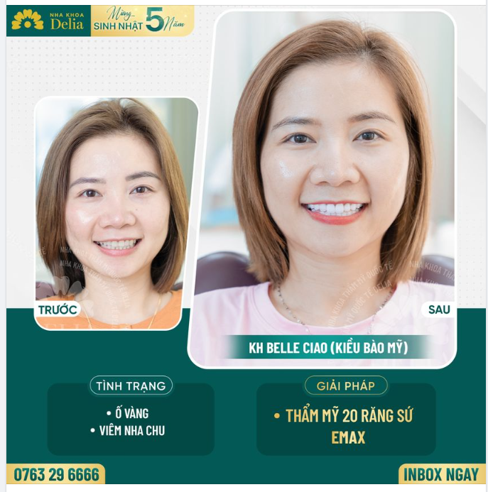 Đến nha khoa Delia làm thẩm mỹ răng sứ