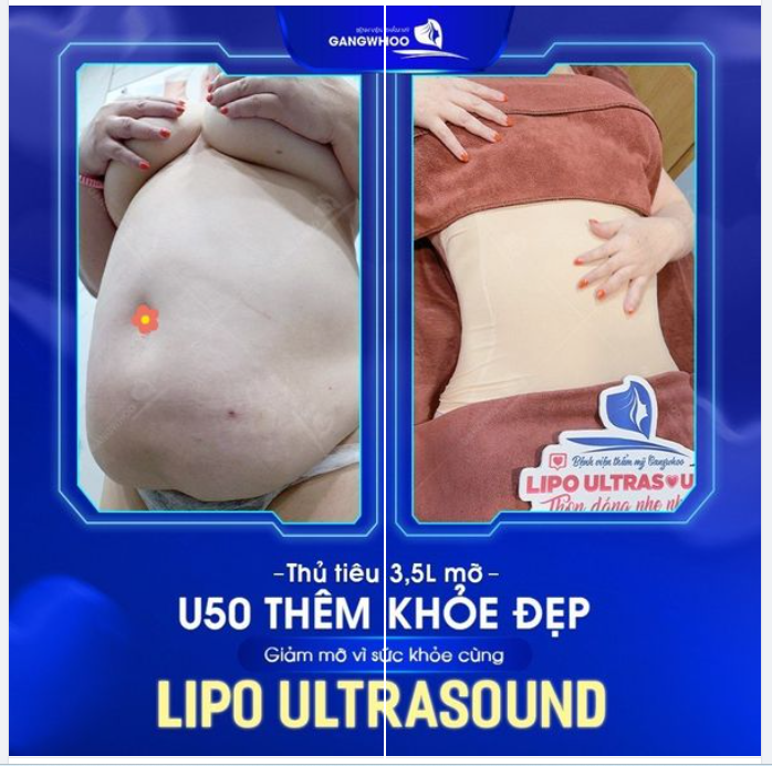 Lipo Ultrasound: thủ tiêu  3,5l mỡ  - U50 thêm khỏe mạnh