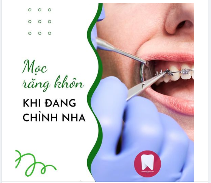 MỌC RĂNG KHÔN KHI ĐANG CHỈNH NHA - LIỆU CÓ ẢNH HƯỞNG GÌ ĐẾN QUÁ TRÌNH NIỀNG RĂNG KHÔNG?