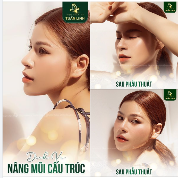 Sở hữu dáng mũi đẹp an toàn với kỹ thuật độc quyền chuyên sâu tại Tuấn Linh!!