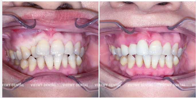 Nếu bạn mang một hàm răng nhiều khuyết điểm thì giờ đây chúng ta không cần lo sợ, thiếu tự tin khi phải sống chung với hàm răng đó cả đời.