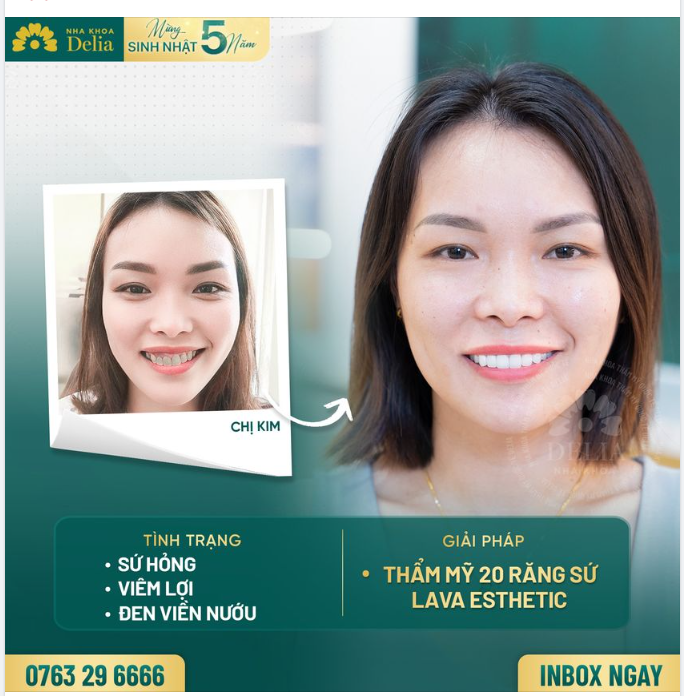 Lựa chọn bọc 20 răng sứ toàn sứ Lava Esthetic cao cấp, chị Kim Võ sở hữu nụ cười mới khỏe đẹp trọn vẹn