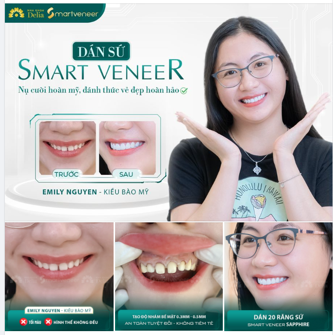 Dán sứ Smart Veneer - Không tiêm tê - An toàn tuyệt đối