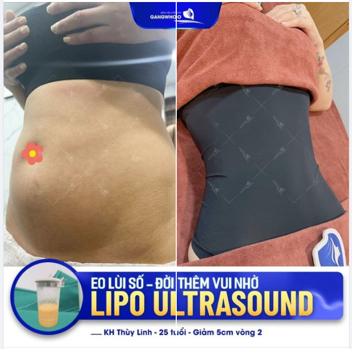 Lipo Ultrasound :"đẩy lùi" số đo eo cho nàng 9x thêm yêu kiều