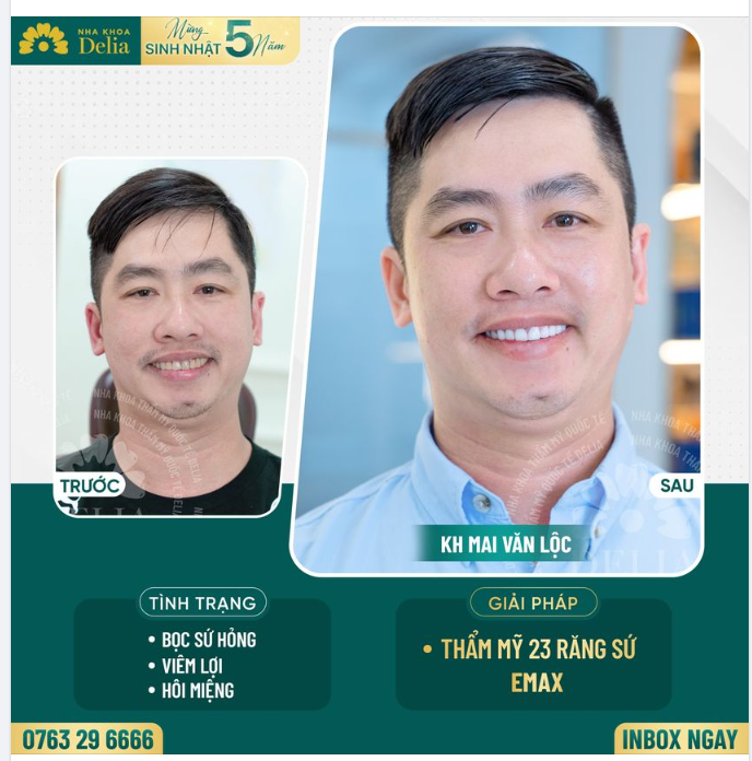 Xử lý răng sứ hỏng - Kiến tạo nụ cười sáng khỏe, bền đẹp