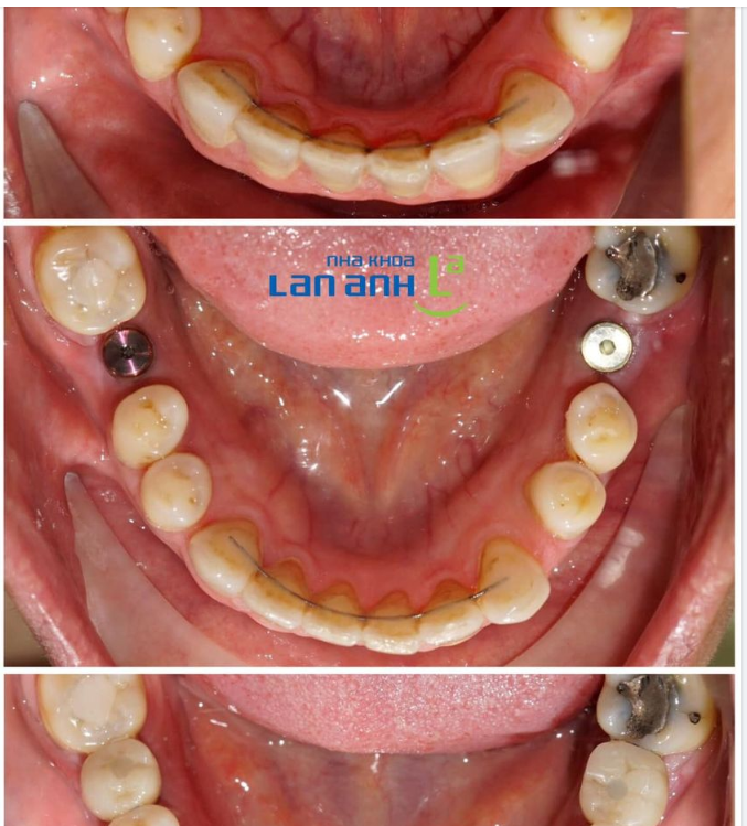 Hình ảnh một ca điều trị mất răng 36, 46 được phục hồi bằng trụ Implant và răng sứ Cercon, do Bác Sĩ Trần Quốc Lân chi nhánh Huỳnh Văn Bánh, Phú Nhuận thực hiện.