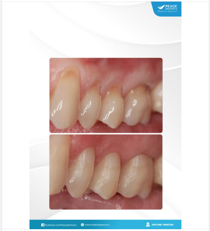 MÒN CỔ CHÂN RĂNG: Đâu là cách điều trị?