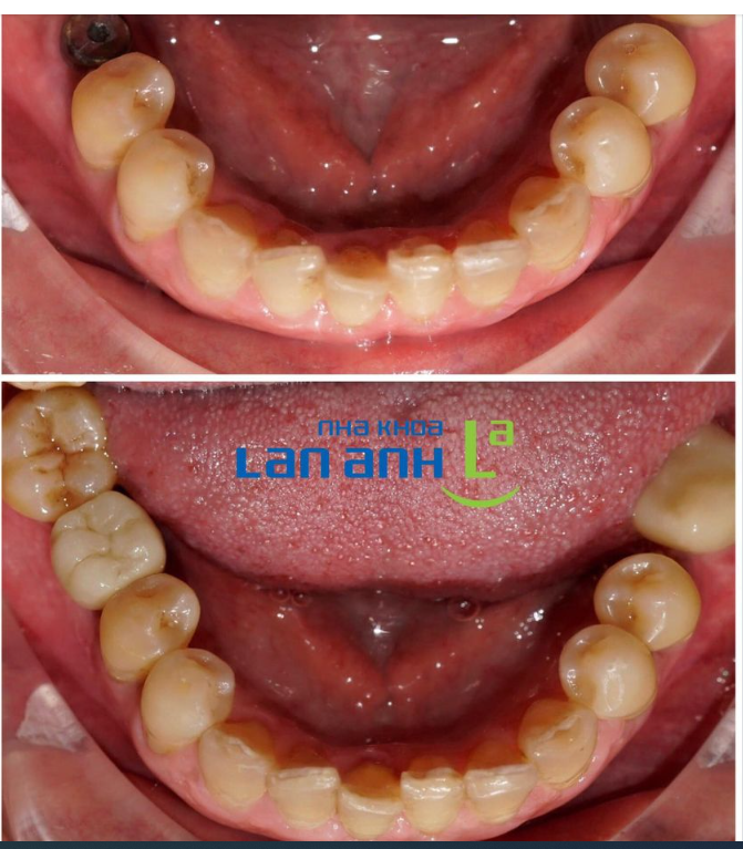 Hình ảnh một trường hợp mất răng 46, được Bác sĩ Trần Quốc Lân tư vấn cắm Implant MIS C1 và phục hình răng sứ trên Implant sau 3 tháng tại chi nhánh Huỳnh Văn Bánh, Phú Nhuận.