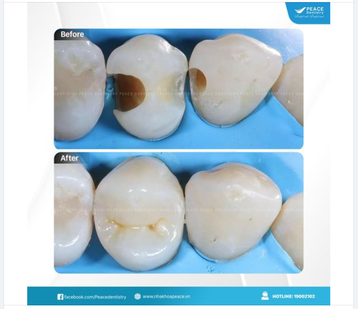 TRÁM RĂNG HIỆU QUẢ VƯỢT TRỘI TẠI PEACE DENTISTRY