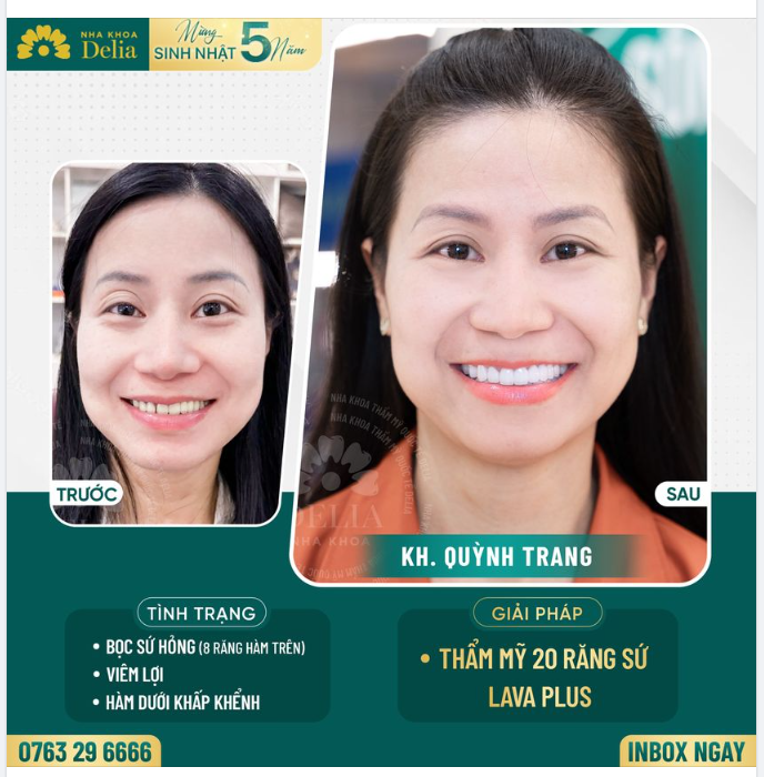 Do trước đây từng bọc sứ 8 răng hàm ở nha khoa khác kém uy tín, chị Quỳnh Trang gặp tình trạng viêm lợi, hôi miệng gây ảnh hưởng đến giao tiếp và chất lượng cuộc sống.