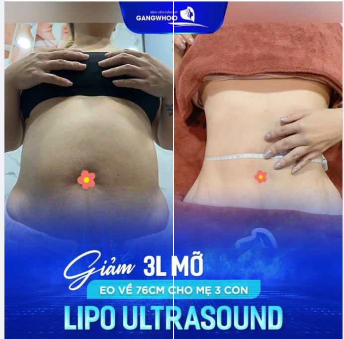 Lipo Ultrasound: Giảm 3L mỡ, eo về 76cm cho mẹ 3 con