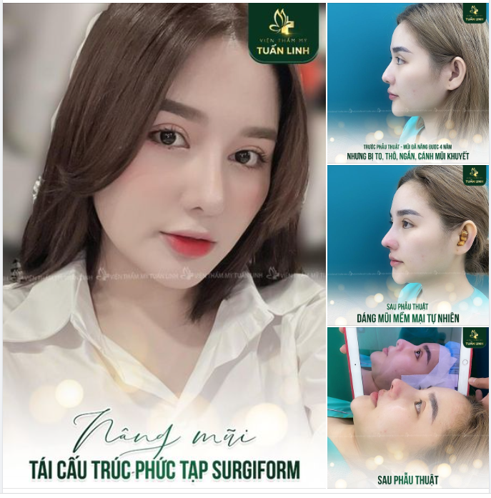 Mũi đã nâng cấu trúc được 4 năm nhưng bị to, thô, đầu mũi ngắn hếch, cánh mũi khuyết = Bạn ấy chọn nâng mũi tái cấu trúc phức tạp sử dụng sụn Surgiform.